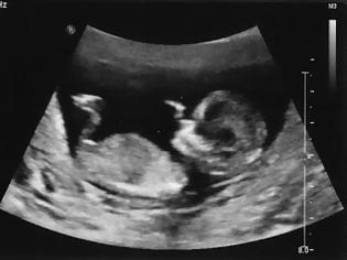 Φωτογραφία για Απίστευτο 40χρονη έγκυο: Δεν είχε καταλάβει ότι ήταν… έγκυος! Μεταφέρθηκε στο ΠΠΝΠ ...