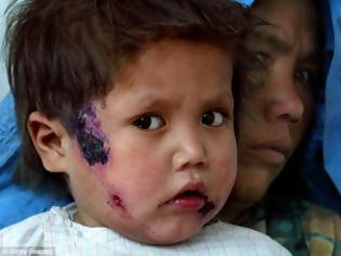Φωτογραφία για Σοκαριστικό: Το ISIS έχει εξαπλώσει ιό που τρώει το δέρμα των ανθρώπων! Δείτε τις φρικιαστικές εικόνες... [photos]