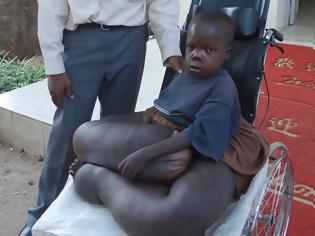 Φωτογραφία για VIDEO | Ανήλικος πάσχει από ελεφαντίαση