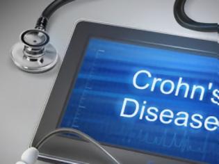 Φωτογραφία για Νόσος Crohn και κολίτιδα: Νέα δεδομένα από αποτελεσματική θεραπεία
