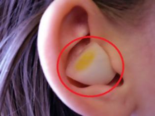 Φωτογραφία για Καταπληκτικό! - Εσείς ξέρατε τι θα συμβεί αν βάλετε σκόρδο στο αυτί σας; Αν ΟΧΙ δείτε το ΕΔΩ!