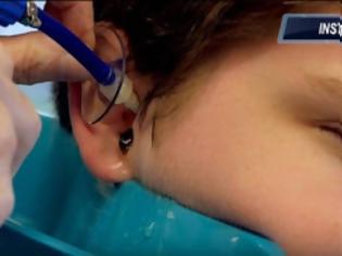 Φωτογραφία για Βίντεο - σοκ: Δείτε τι έβγαλε ο γιατρός από το αφτί αυτού του παιδιού [video]