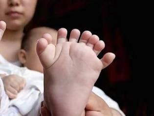 Φωτογραφία για ΑΠΙΣΤΕΥΤΟ: Μωρό στην Κίνα γεννήθηκε με 31 δάχτυλα σε χέρια και πόδια [photos]