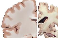 Οι εγκεφαλικές πλάκες που οδηγούν στο Αλτσχάιμερ μπορεί να δημιουργούνται από άμυνα