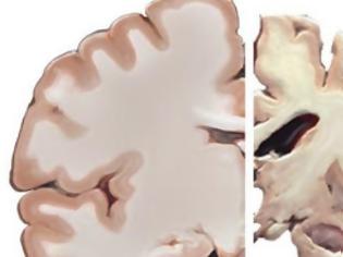 Φωτογραφία για Οι εγκεφαλικές πλάκες που οδηγούν στο Αλτσχάιμερ μπορεί να δημιουργούνται από άμυνα