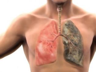 Φωτογραφία για Ο καλύτερος φυσικός τρόπος να καθαρίσετε τους πνεύμονες σας από πίσσα και νικοτίνη