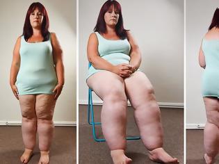 Φωτογραφία για Η 29χρονη με τα πόδια που ζυγίζουν... 50 κιλά!