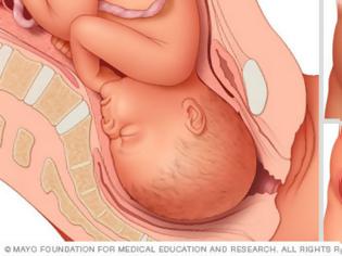 Φωτογραφία για Αυτές είναι οι στάσεις του μωρού μέσα στην μήτρα πριν τον τοκετό!
