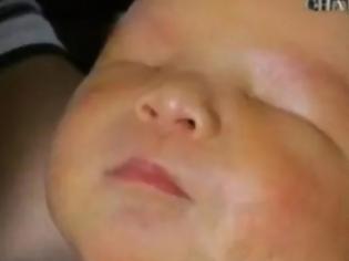 Φωτογραφία για Μωρό γεννήθηκε χωρίς μάτια! [photos + video]
