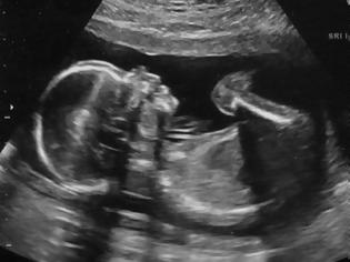 Φωτογραφία για Το έμβρυο είχε κάτι το ΑΦΥΣΙΚΟ! Η φωτογραφία του υπέρηχου που ΣΟΚΑΡΕ