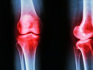 Φωτογραφία για Οστεοαρθρίτιδα γόνατος: Οι παράγοντες κινδύνου & πώς θα μειώσετε τη φθορά