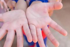 Νόσος του ποδιού, του χεριού και του στόματος! Τι είναι;