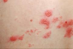 Έρπης ζωστήρ: Ποια είναι τα πρώιμα συμπτώματα, ποιοι κινδυνεύουν