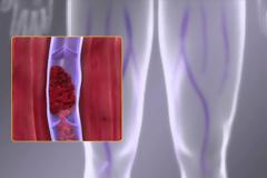 Φλεβική θρόμβωση: Ποιοι κινδυνεύουν από τον «σιωπηλό δολοφόνο»