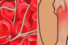 SOS!ΑΥΤΑ είναι τα 4 συμπτώματα της θρόμβωσης