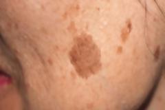 Έχεις καφέ κηλίδες στο πρόσωπό σου; Δες πόσο εύκολα μπορείς να τις εξαφανίσεις με αυτό το ιδιοφυές κόλπο!