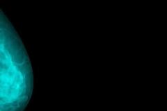 Καρκίνος μαστού: 4 ανησυχητικά σημάδια εκτός από τους ψηλαφητούς όγκους [photos]