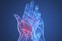 Ρευματοειδής αρθρίτιδα: Τί είναι, τα συμπτώματα και η κατάλληλη διατροφή