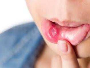 Φωτογραφία για Άφθες στο στόμα: Το λαχανικό που τις εξαφανίζει