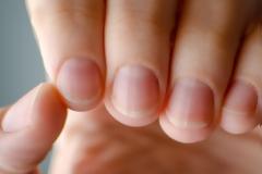 Πέντε συμπτώματα στα νύχια που δείχνουν ύπουλα προβλήματα υγείας