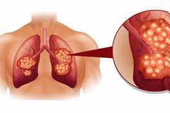 Καρκίνος του πνεύμονα: Τα 8 σημάδια που θα πρέπει να σας προβληματίσουν