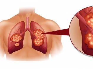 Φωτογραφία για Καρκίνος του πνεύμονα: Τα 8 σημάδια που θα πρέπει να σας προβληματίσουν