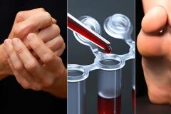 Ρευματοειδής αρθρίτιδα: Τα πέντε προειδοποιητικά σημάδια για έγκαιρη θεραπεία