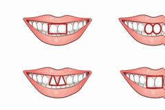 Τα μπροστινά σας δόντια είναι ΈΤΣΙ; Αυτό σημαίνει ότι...