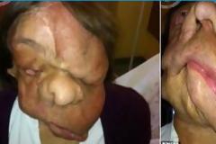 Θυμάστε τον άντρα που πριν 3 χρόνια έγινε ο 1ος άνθρωπος που έκανε ΟΛΙΚΗ μεταμόσχευση προσώπου; Δείτε ΠΩΣ είναι σήμερα [photos]