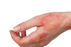 Έγκαυμα: Βήμα-βήμα η σωστή αντιμετώπιση