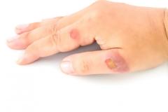 Σταφυλόκοκκος: Εικόνες, συμπτώματα, αίτια, θεραπεία και πρόληψη