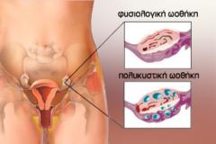 Σύνδρομο πολυκυστικών ωοθηκών και ινσουλινοαντίσταση: Πώς σχετίζονται;