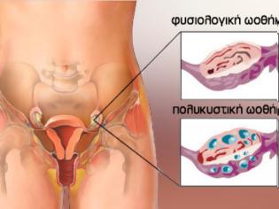 Φωτογραφία για Σύνδρομο πολυκυστικών ωοθηκών και ινσουλινοαντίσταση: Πώς σχετίζονται;