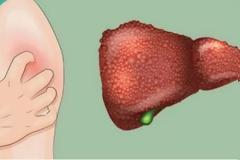 Μελανιαζετε εύκολα; Εχετε φαγούρα στο δέρμα; 5 σημάδια ότι έχετε πρόβλημα στο...