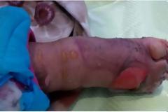 Εικόνα-γροθιά στο στομάχι: To παραμορφωμένο από το κρύο πόδι προσφυγόπουλου