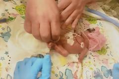 Το θαύμα της ζωής: Μωρό γεννήθηκε 623 γραμμάρια, έκανε 11 λεπτά να αναπνεύσει και επέζησε!