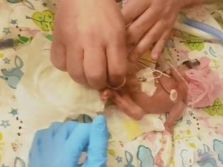 Φωτογραφία για Το θαύμα της ζωής: Μωρό γεννήθηκε 623 γραμμάρια, έκανε 11 λεπτά να αναπνεύσει και επέζησε!