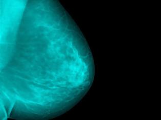 Φωτογραφία για Καρκίνος του μαστού: Ο ρόλος των αποβολών