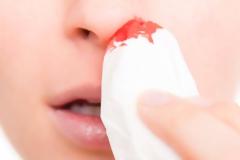 Πώς μπορείτε να σταματήσετε τη ρινορραγία...