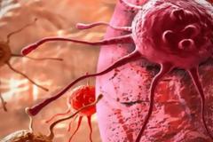 Τεστ αναπνοής θα ανιχνεύει τον καρκίνο του στομάχου