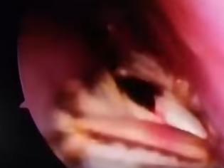 Φωτογραφία για ΦΡΙΚΗ! Βρέθηκε ζωντανή κατσαρίδα μέσα στο κρανίο 42Χρόνης - ΑΝΑΤΡΙΧΙΑΣΤΙΚΟ βίντεο