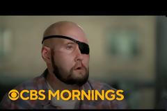 Η πρώτη μεταμόσχευση ματιού είναι γεγονός: «Μου άλλαξε τη ζωή»